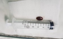 Gắp hạt dưa ở phế quản, cứu cháu bé 23 tháng tuổi