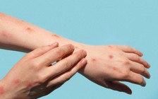 Đậu mùa khỉ có thể lây trước khi triệu chứng xuất hiện