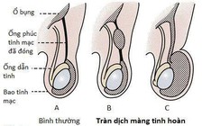 Bác sĩ nói gì về trường hợp bé trai có '3 tinh hoàn'?