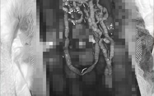 Sán dải bò dài hơn 1 mét trong bụng người đàn ông gây xuất huyết ồ ạt