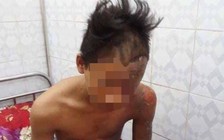 Bị sét đánh cháy xém, nam sinh lớp 10 may mắn thoát chết