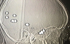 Nghịch súng tự chế, bé trai 6 tuổi bị 11 viên đạn bi găm vào đầu, tử vong