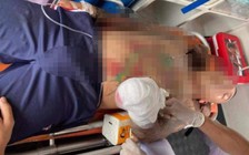 Thanh Hóa: Nạn nhân bị anh rể chém đứt lìa bàn tay