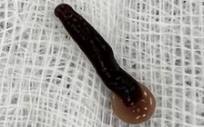 Con đỉa dài 5 cm sống cả tuần trong mũi người đàn ông