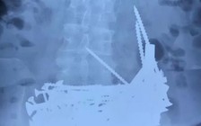 Bệnh nhân sốt, nội soi phát hiện 1kg đinh vít trong dạ dày