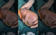 Bé trai sinh non nằm nguyên trong túi nước ối