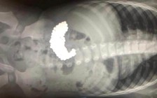 Bác sĩ sốc khi phát hiện 209 viên bi nam châm trong bụng bé trai 2 tuổi