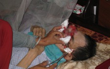 Bệnh quái ác ‘ăn’ mòn khuôn mặt người đàn ông 56 tuổi