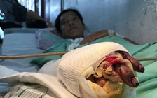 Mổ khẩn cấp nối 4 ngón tay bị đứt của bệnh nhân 17 tuổi