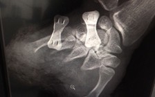 Cắt cỏ cho dê ăn, sơ ý bị cắt luôn bàn tay