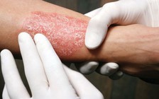 Bệnh vẩy nến nghiêm trọng làm tăng rủi ro tiểu đường