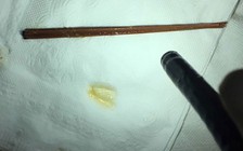 Gắp ra ngoài 6 cây nhang từ ruột non bệnh nhân