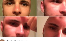 Phơi nắng quá lâu, chàng trai bị cháy nắng nặng gây phỏng