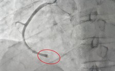 Tư vấn qua điện thoại với người nhà để can thiệp tim cấp cứu cho bệnh nhân