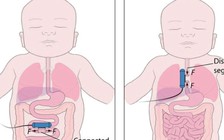 Cấy 'robot' vào cơ thể để điều trị dị tật teo thực quản bẩm sinh