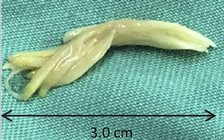 Cậu bé nguy kịch do bị miếng thịt gà chèn đường thở