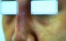 Cô gái bơm chất làm đầy mũi ở spa rồi... nhập viện cấp cứu