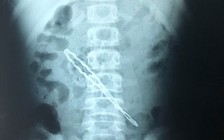Cứu bé gái bị thủng ruột do... nuốt kẹp tóc