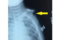 Đau lòng bé gái chơi trốn tìm ngã vào máy cưa bị đứt cánh tay