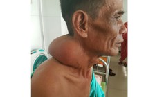 Cắt khối u 3 kg 'đeo' trên cổ bệnh nhân hơn 30 năm