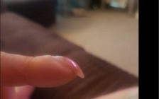 Nếu móng tay cong quặp xuống, đến bệnh viện ngay!