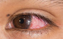 Chớ mang kính sát tròng khi ngủ, vì sao?