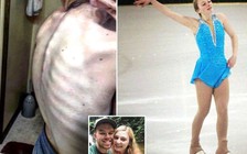 Cô gái suýt chết vì chỉ ăn 'một quả táo mỗi ngày'