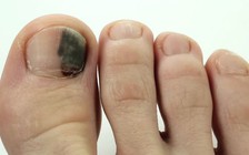 Có dấu hiệu này trên móng tay, móng chân, hãy kiểm tra ung thư ngay!
