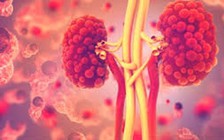 Người bị bệnh thận nên tránh những thực phẩm này