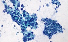 Phát hiện bất ngờ về bệnh ung thư tuyến tụy