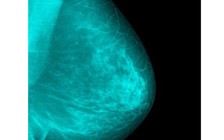 Hai nguyên nhân chính gây ung thư vú có thể tránh được