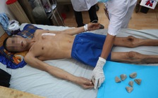 Bác sĩ, bệnh nhân cùng sốc: 7 viên sỏi nặng gần nửa kg nằm trong bàng quang