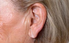 Dấu hiệu lạ ở tai báo hiệu cơn đau tim chết người
