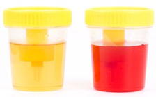 Những triệu chứng ung thư bàng quang, chớ coi thường!