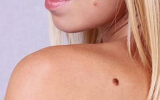 Phát hiện ung thư da nhờ cảnh báo từ phần mềm điện thoại