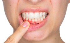 Bệnh nướu răng và nguy cơ đột quỵ