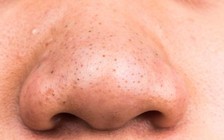 4 cách xử lý mụn đầu đen trên mũi và cằm
