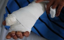 Đồng Nai: Khỉ nuôi xổng khỏi chuồng cắn đứt gân tay 2 người đàn ông