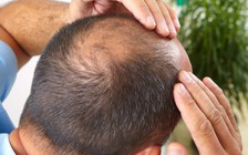 7 dấu hiệu thầm lặng chỉ ra cục máu đông chết người đang gây tắc nghẽn động mạch