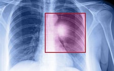 Những dấu hiệu báo động ung thư phổi đã di căn