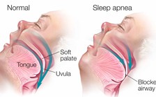 Ngưng thở khi ngủ, coi chừng có ngày 'ngủ' luôn