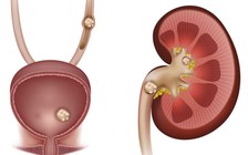Cẩn thận với tình trạng thường gặp này vì rất dễ dẫn đến suy thận