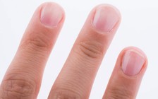 Thấy móng tay có hiện tượng này, mau đi khám bệnh tiểu đường