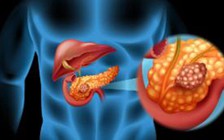 Thấy hiện tượng này khi đi vệ sinh, mau đi khám ung thư