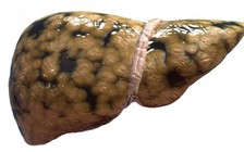 Bị gan nhiễm mỡ: Đừng lo, hãy thử 10 bài thuốc này