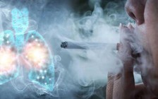 Làm chỉ 2 điều này bạn có thể tránh được 4/10 bệnh ung thư