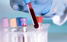 Phương pháp mới phát hiện ung thư chính xác đến 94%