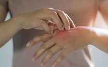 Nên xét nghiệm Covid-19 nếu thấy những dấu hiệu này trên da