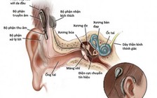 Cấy ốc tai điện tử điều trị điếc bẩm sinh