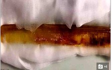 Vô tình nuốt cây lược dài 20 cm vào bụng